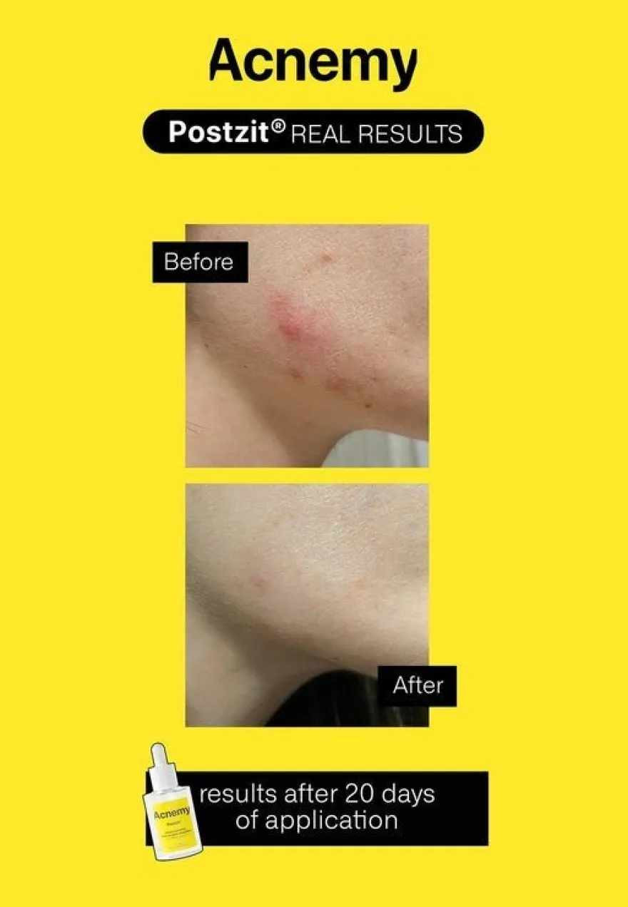 Acnemy Postzit 30 ml