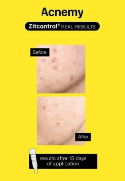 Acnemy Zitcontrol 40 ml