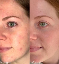 CAUDALIE Vinopure Sérum Salicílico Anti-Imperfecciones 30ml