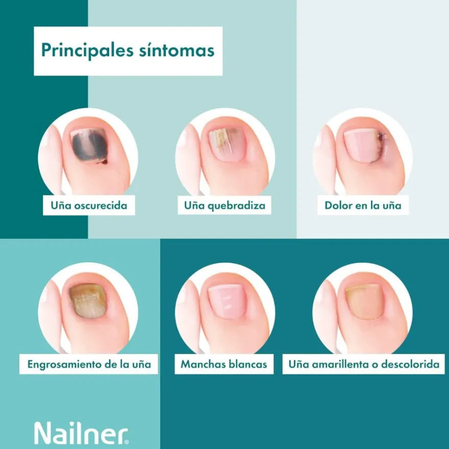Nailner Pincel Antihongos Uñas 2 en 1